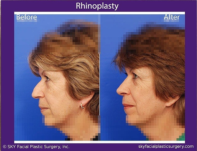 Rhinoplasty Before & After