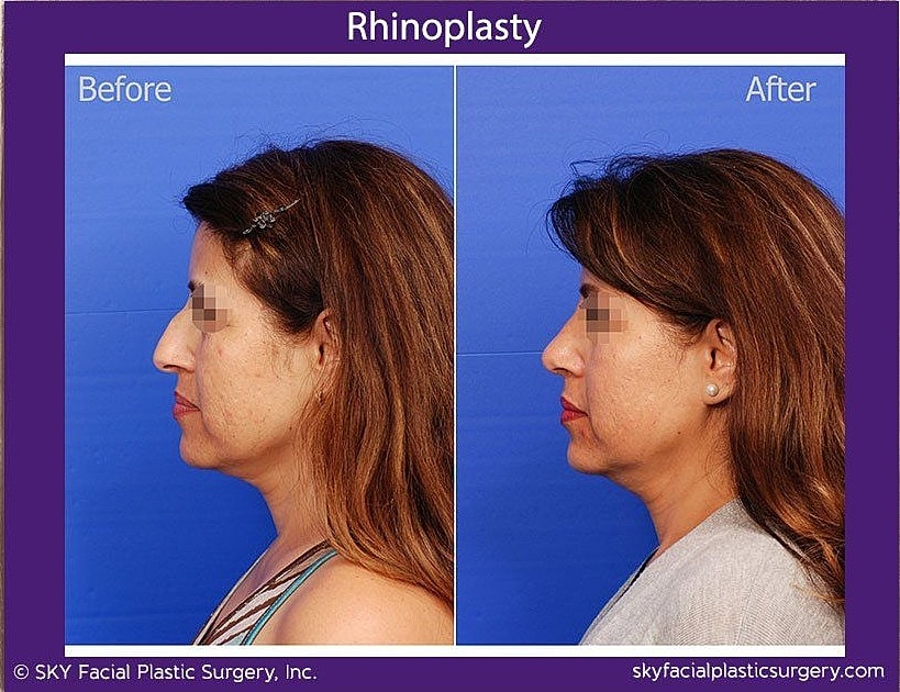 Rhinoplasty Before & After
