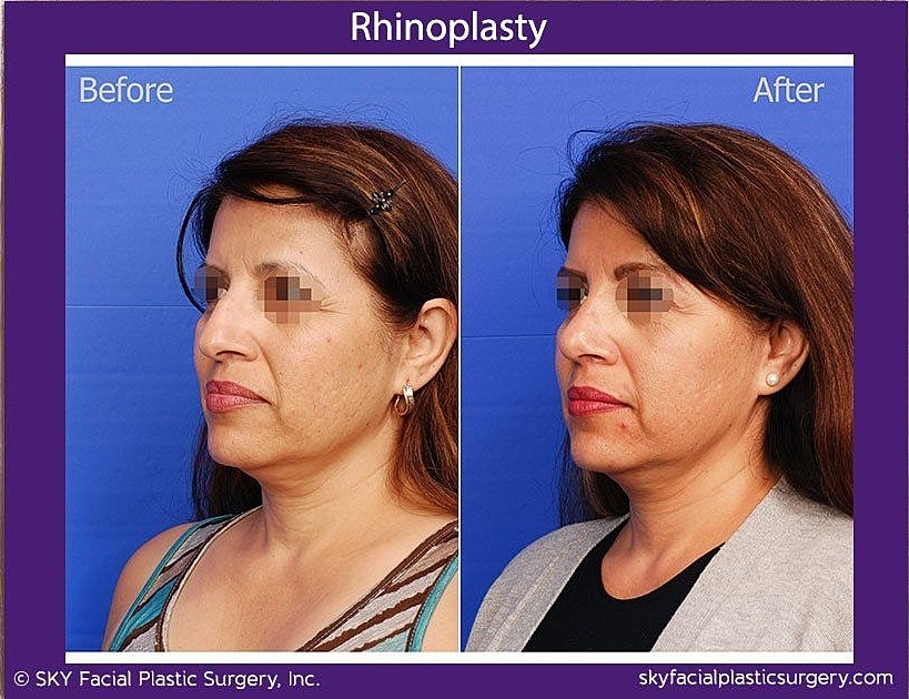 Rhinoplasty Before & After