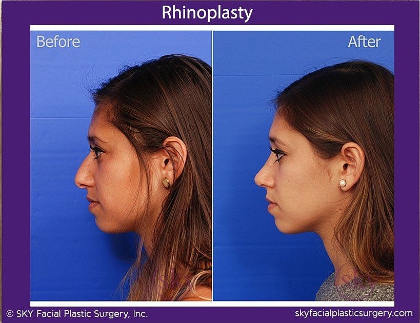Rhinoplasty Before & After