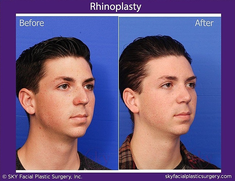 Rhinoplasty Before & After