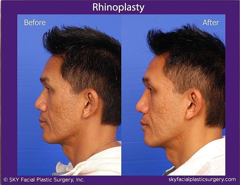Rhinoplasty Before & After
