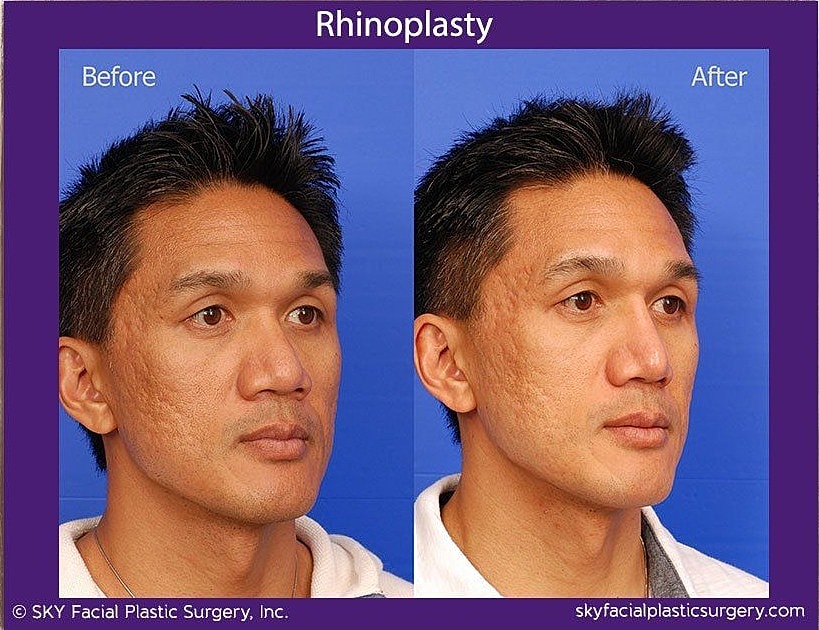 Rhinoplasty Before & After