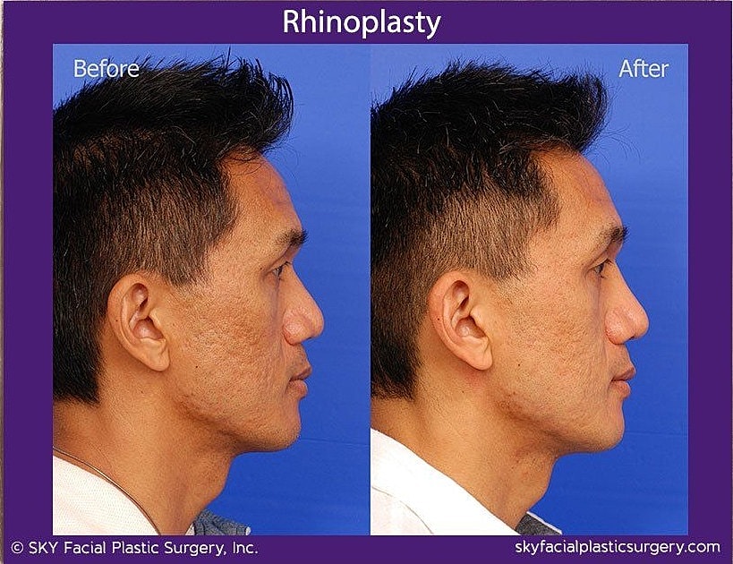 Rhinoplasty Before & After