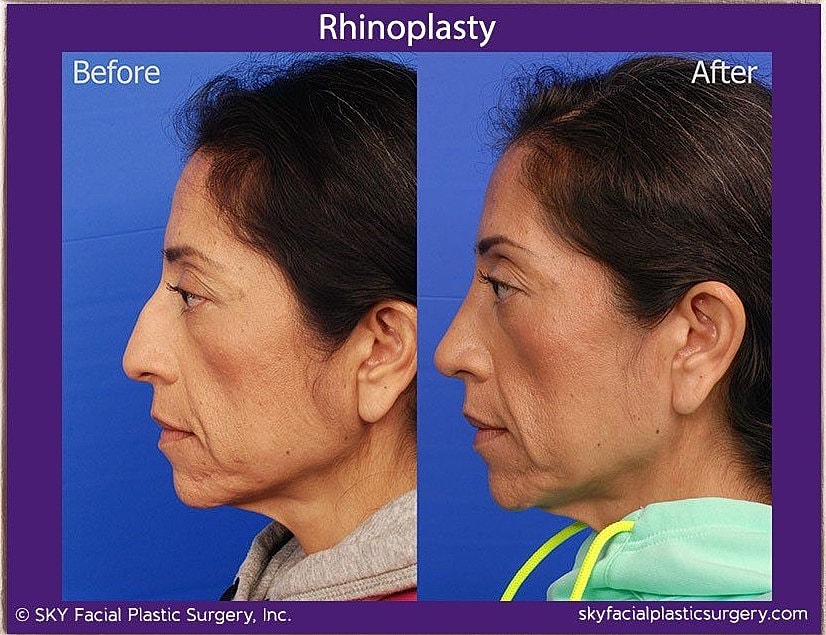 Rhinoplasty Before & After