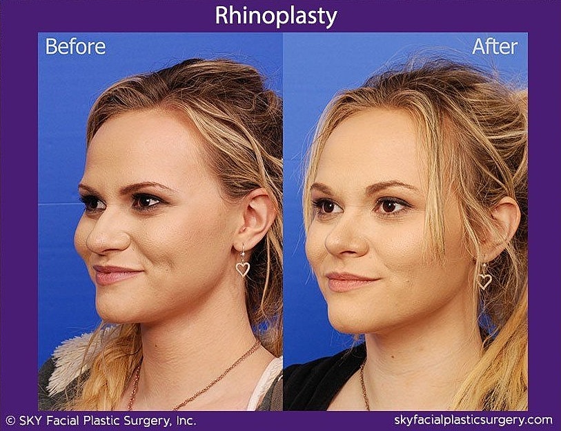 Rhinoplasty Before & After
