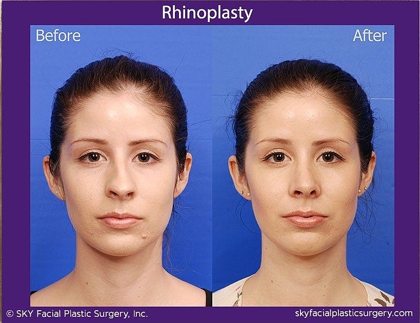 Rhinoplasty Before & After