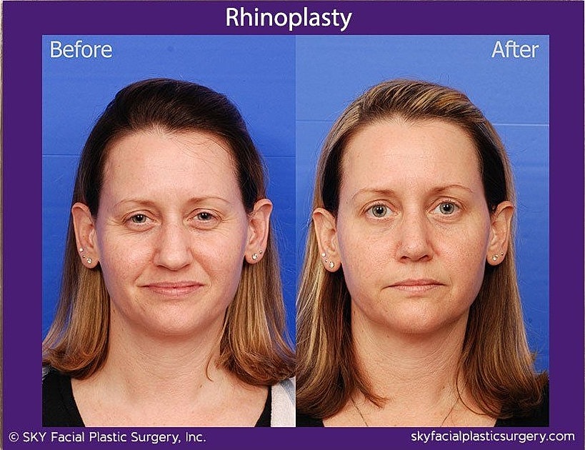 Rhinoplasty Before & After