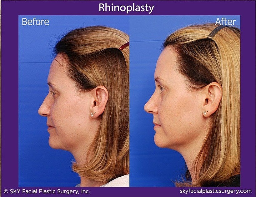 Rhinoplasty Before & After