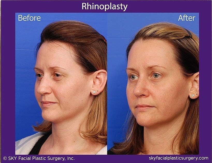Rhinoplasty Before & After