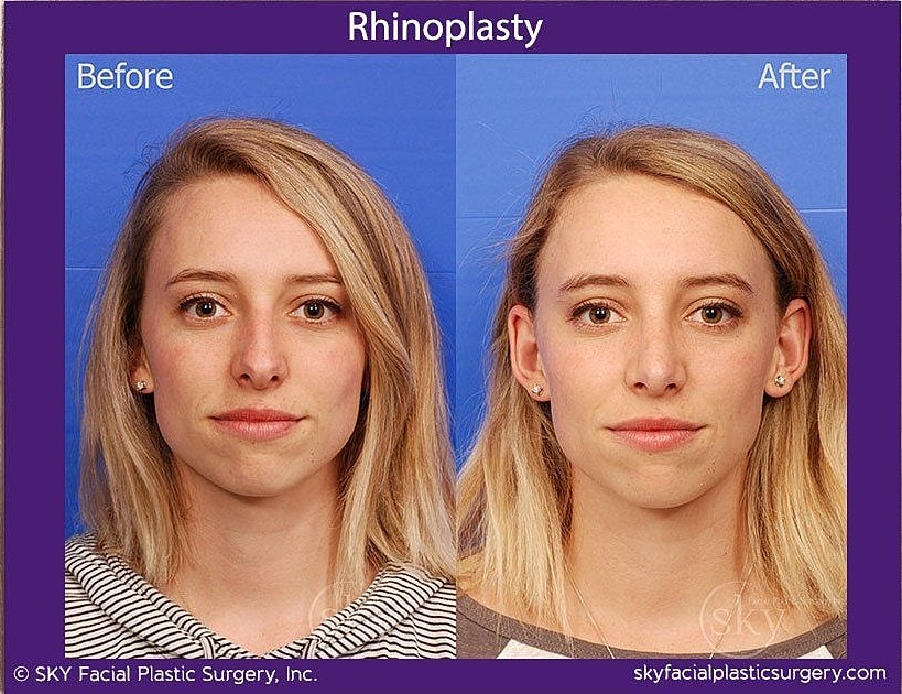 Rhinoplasty Before & After