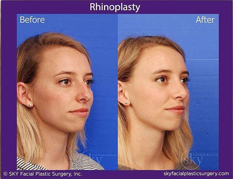 Rhinoplasty Before & After