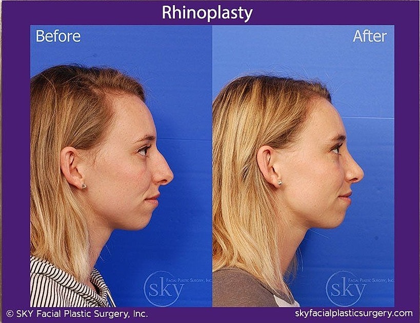 Rhinoplasty Before & After