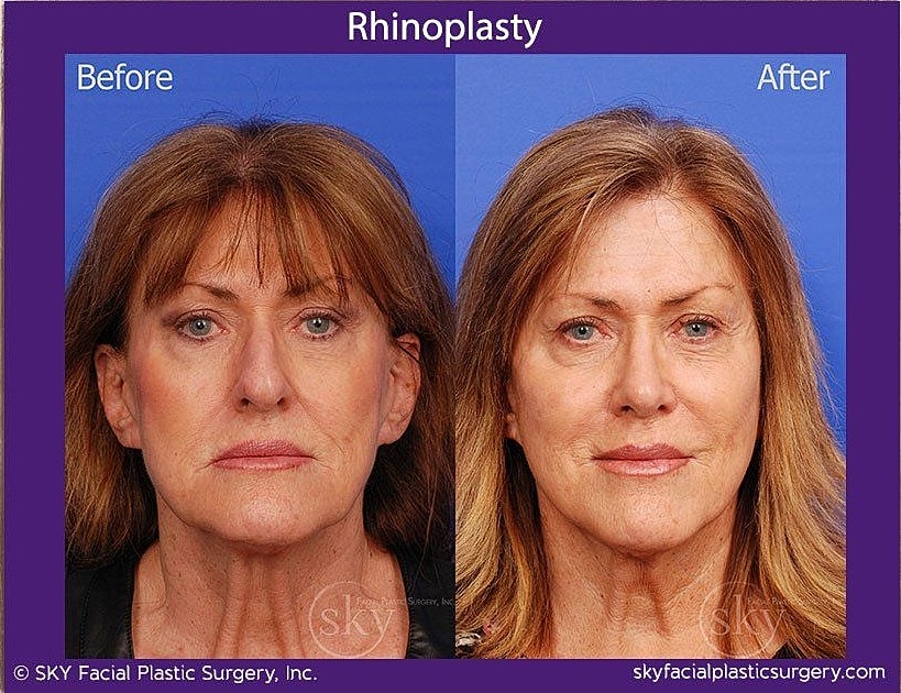 Rhinoplasty Before & After