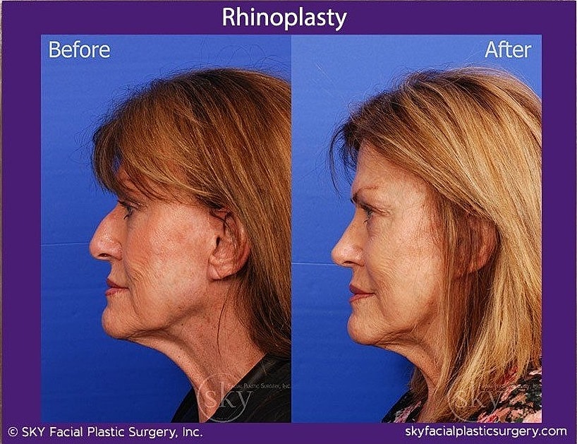 Rhinoplasty Before & After