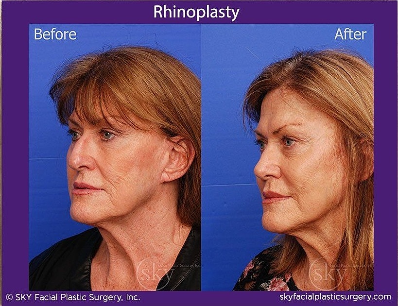 Rhinoplasty Before & After