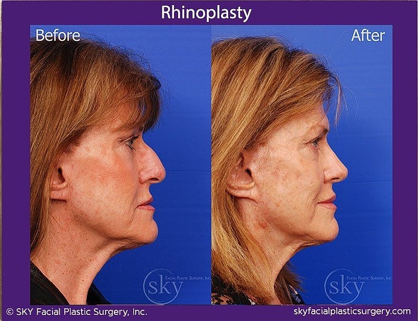 Rhinoplasty Before & After