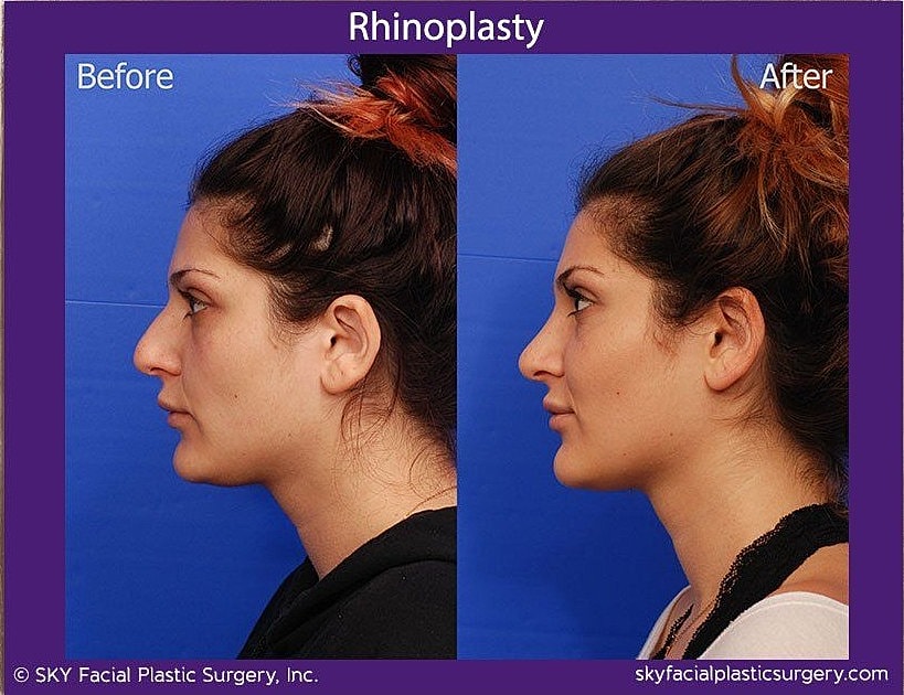 Rhinoplasty Before & After