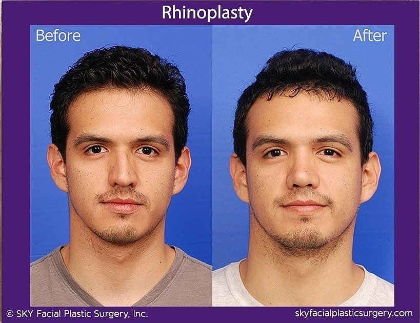 Rhinoplasty Before & After
