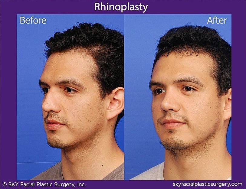 Rhinoplasty Before & After