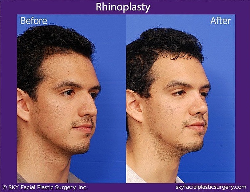 Rhinoplasty Before & After