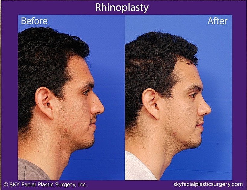 Rhinoplasty Before & After