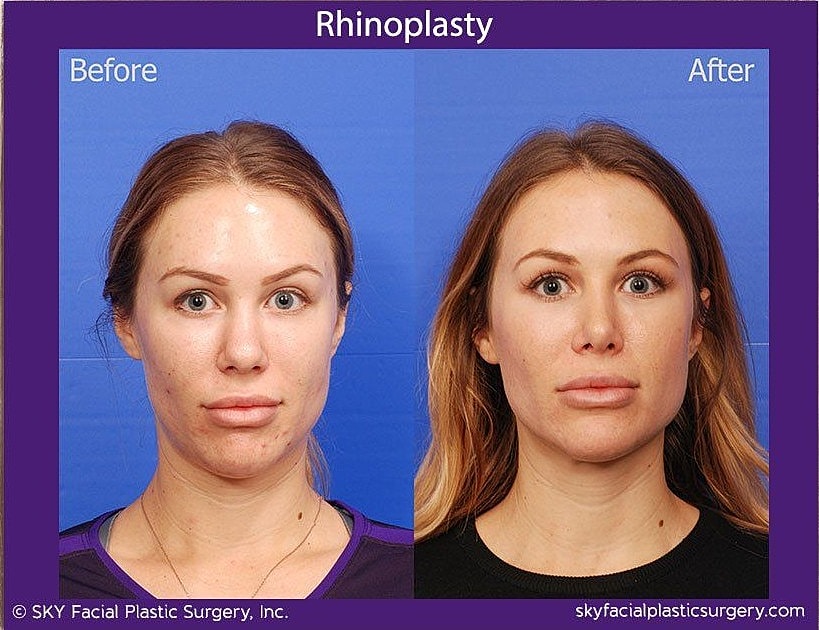 Rhinoplasty Before & After