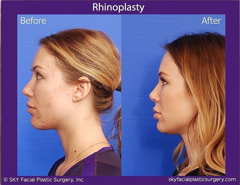 Rhinoplasty Before & After