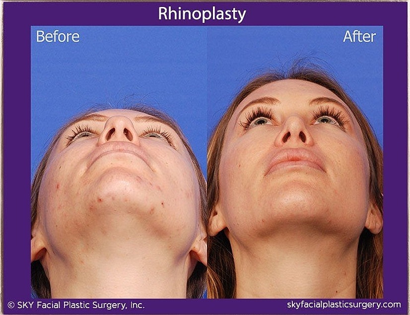 Rhinoplasty Before & After