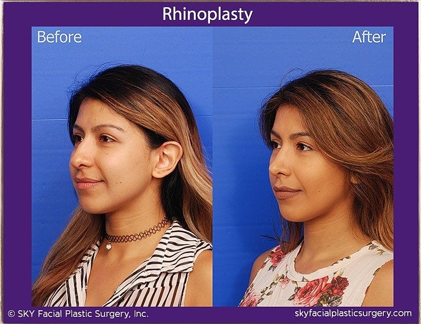 Rhinoplasty Before & After