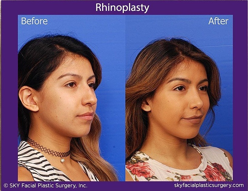 Rhinoplasty Before & After