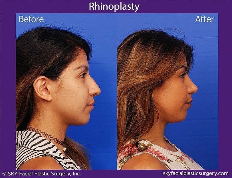 Rhinoplasty Before & After