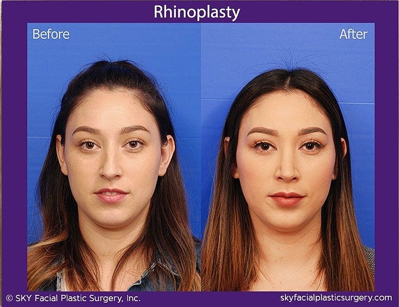 Rhinoplasty Before & After
