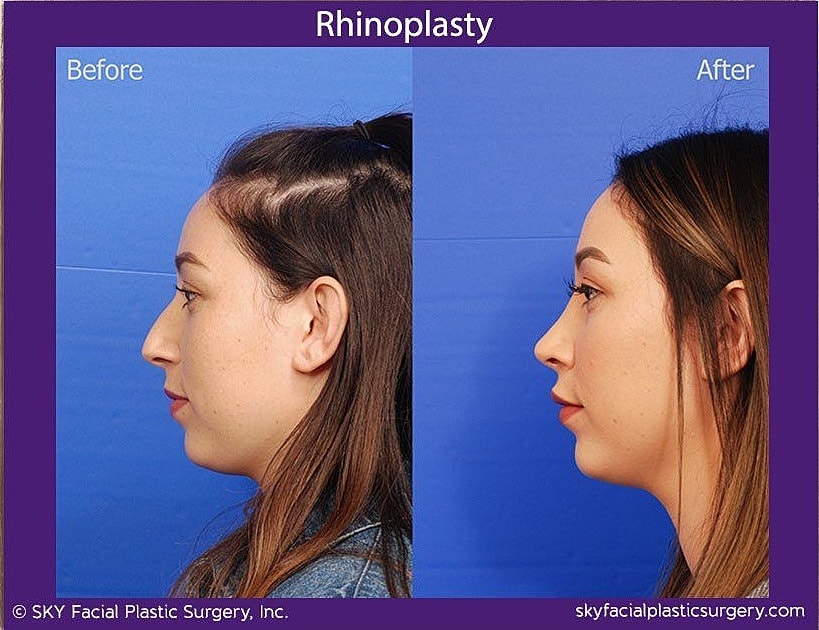 Rhinoplasty Before & After