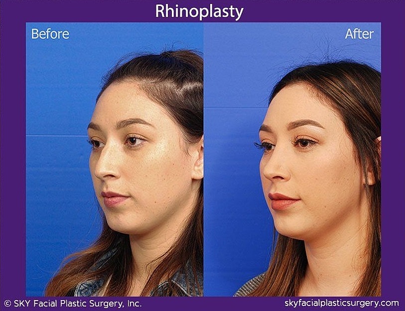 Rhinoplasty Before & After