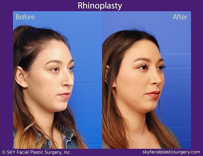 Rhinoplasty Before & After