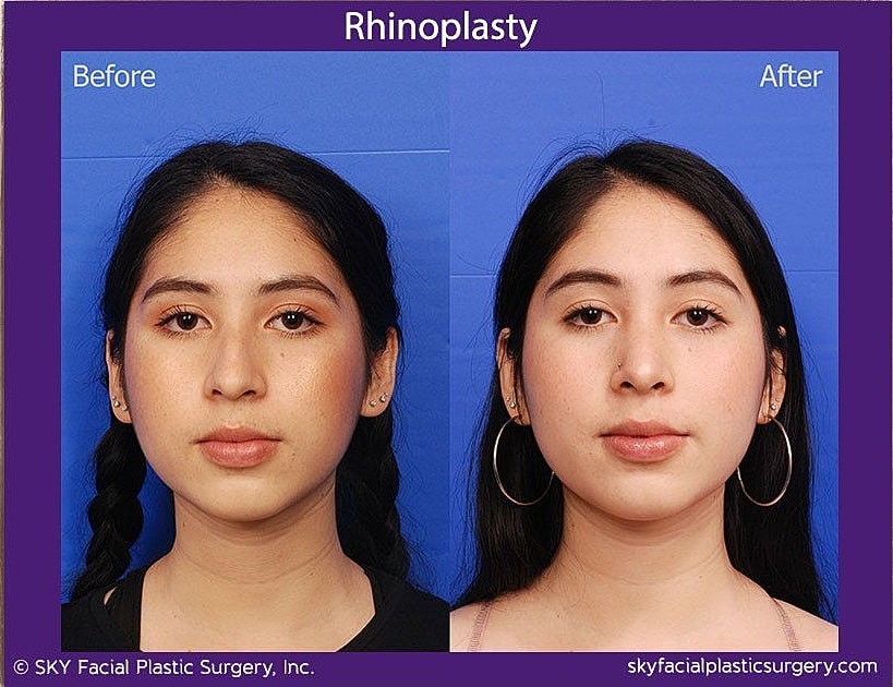 Rhinoplasty Before & After