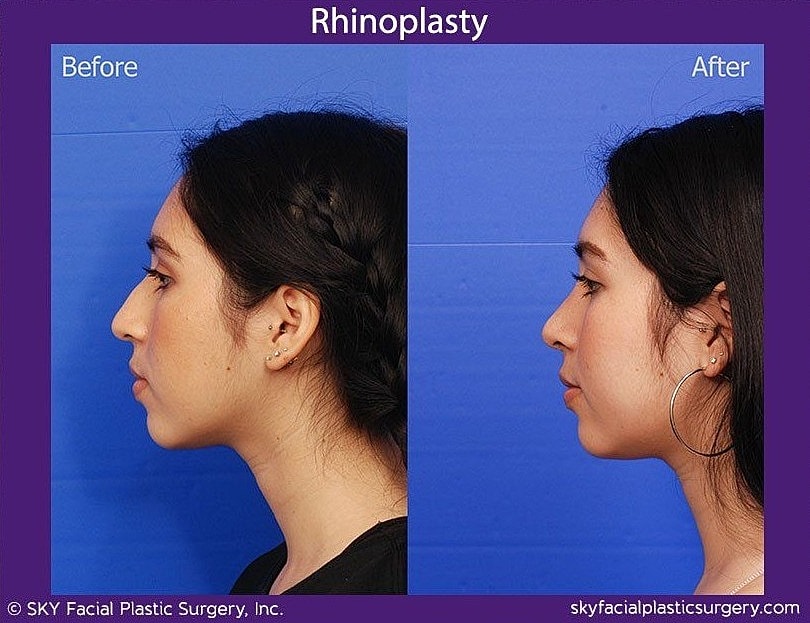 Rhinoplasty Before & After