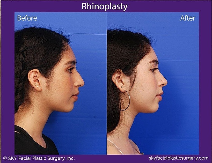 Rhinoplasty Before & After
