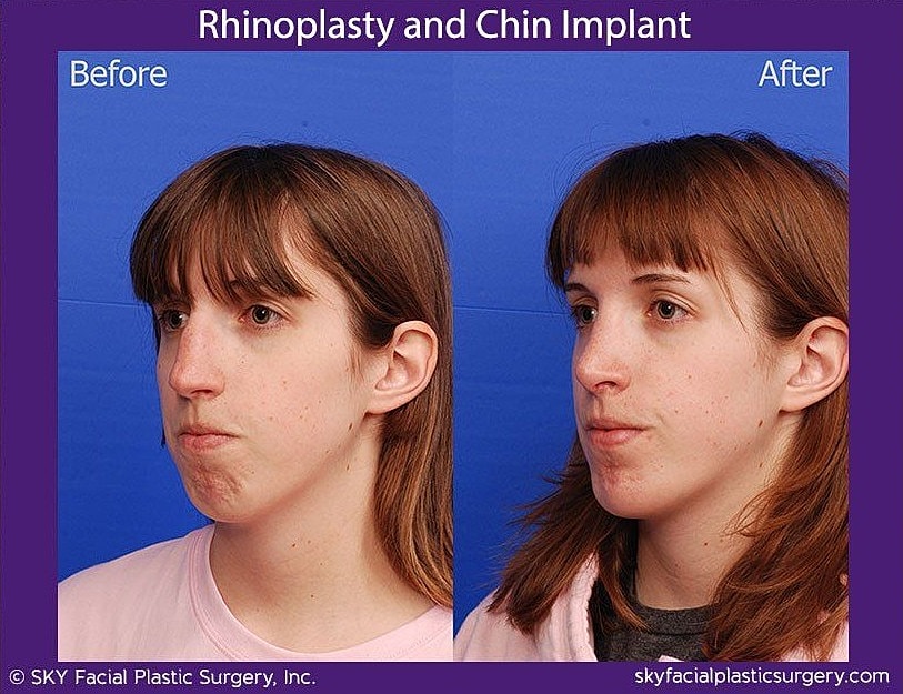 Rhinoplasty Before & After