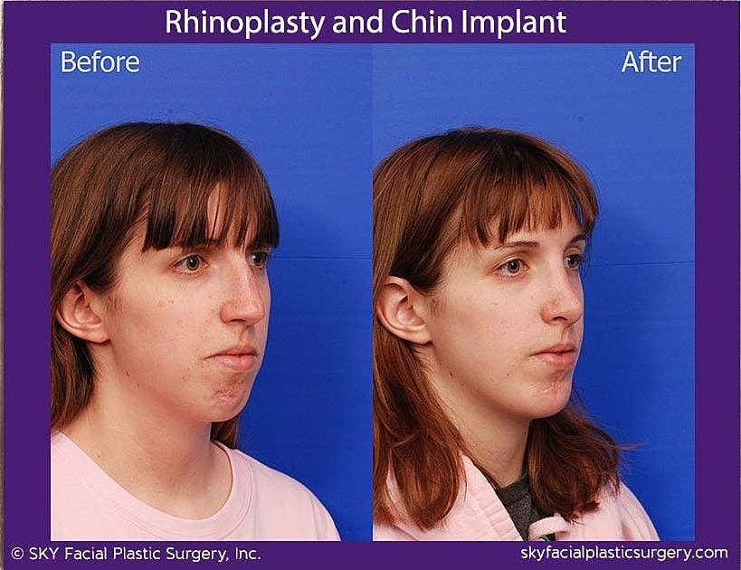 Rhinoplasty Before & After