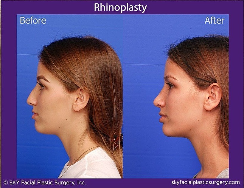 Rhinoplasty Before & After