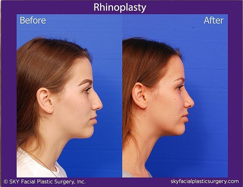 Rhinoplasty Before & After
