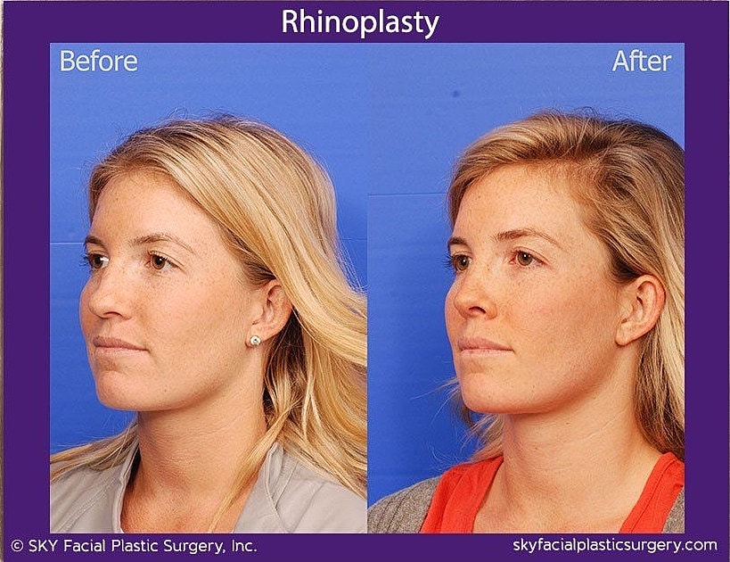 Rhinoplasty Before & After