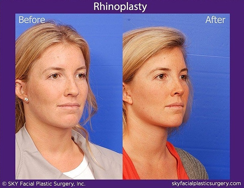 Rhinoplasty Before & After
