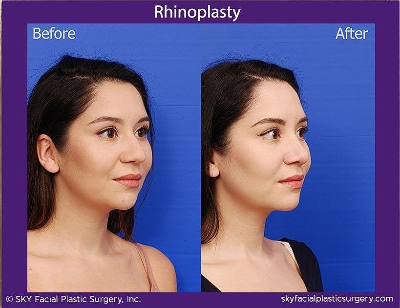 Rhinoplasty Before & After