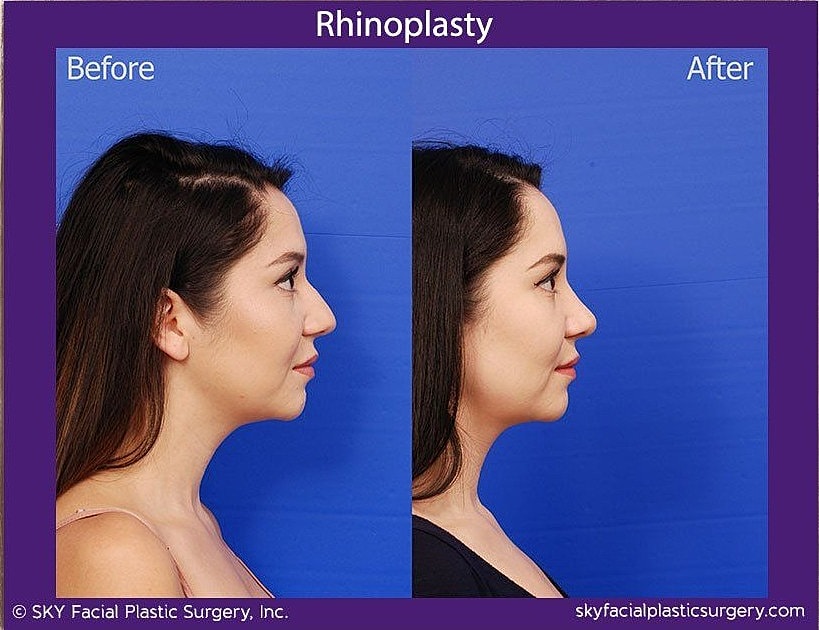 Rhinoplasty Before & After
