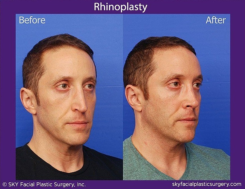 Rhinoplasty Before & After