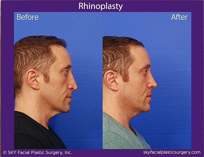 Rhinoplasty Before & After