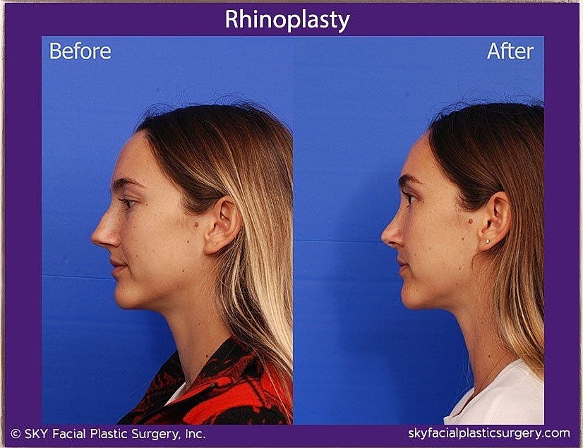 Rhinoplasty Before & After